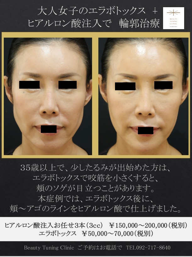 エラボトックス ヒアルロン酸注入でフェイスラインを整える Beauty Tuning Clinic 院長西田美穂のブログ