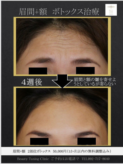 眉間と額のボトックス治療