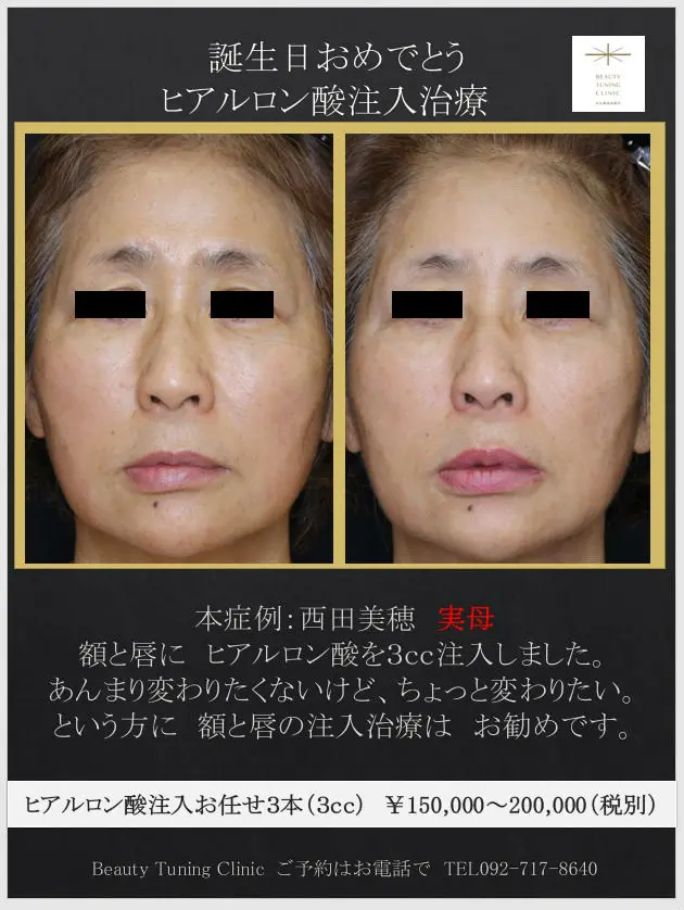 額と唇のヒアルロン酸注入（実母） | Beauty Tuning Clinic