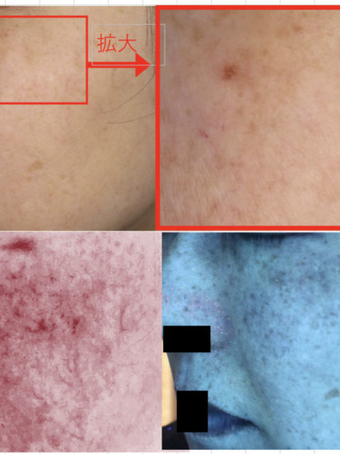 ピーリング治療について思うこといろいろ