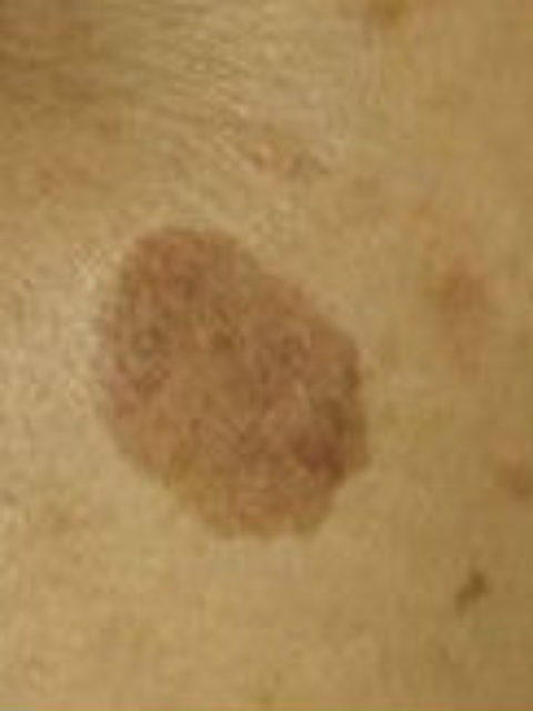 シミの治療色々Ｑ＆Ａ