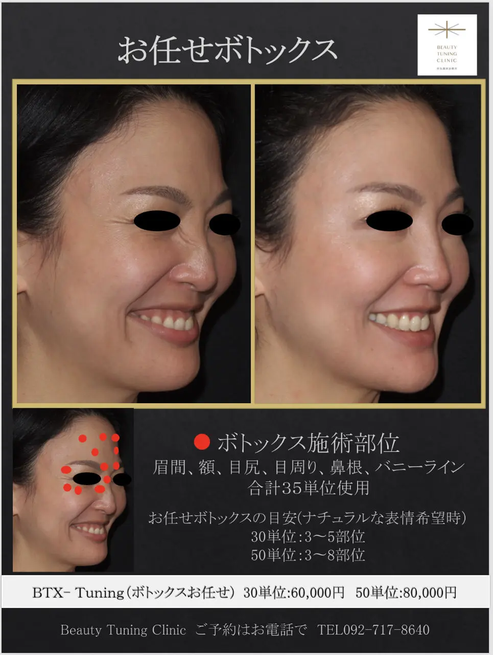お任せボトックス、あるいはTuning BTX®︎もしくは表情筋調律