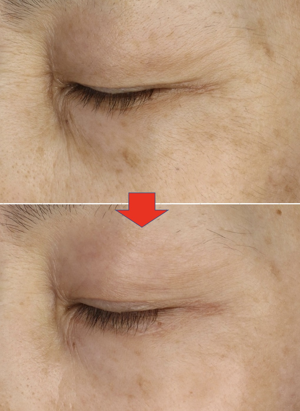 ゼオスキン症例：ハイドラファームで目周り改善 | Beauty Tuning Clinic