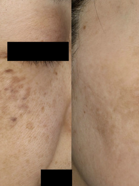 後天性両側性太田母斑様色素斑（ABNOM）後天性両側性真皮メラノサイトーシス（ADM）の症例
