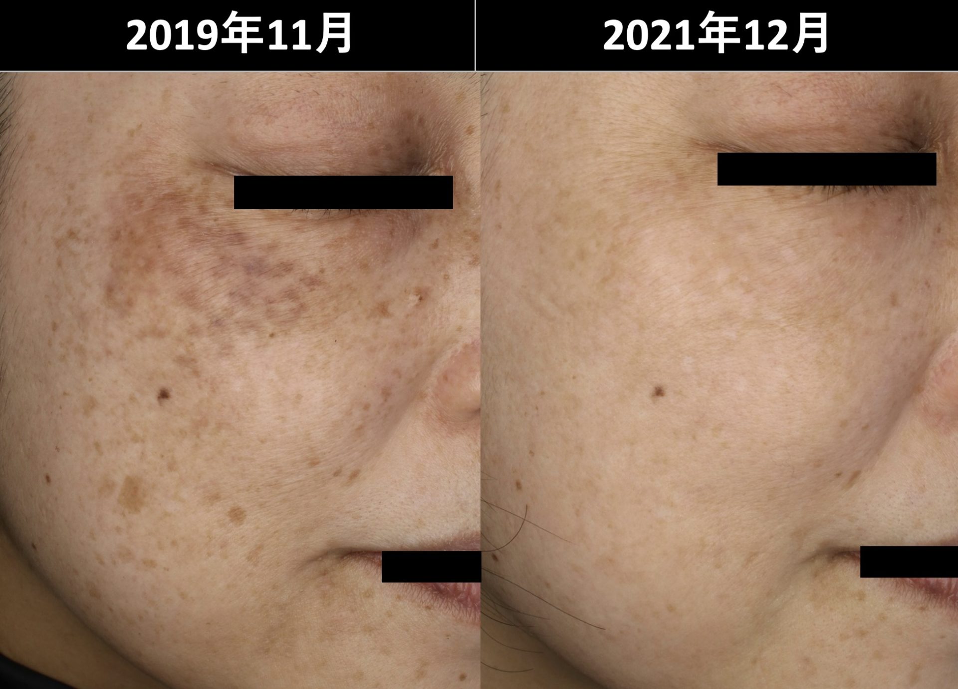ADM （両側性遅発性太田母斑様色素斑）の正しい治療 - SSクリニック - 皮膚科・美容外科 - 名古屋市中区