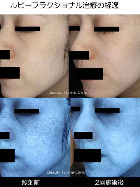 ルビーフラクショナルレーザーによるシミ治療　２０代女性　鼻〜頬に多発するシミ