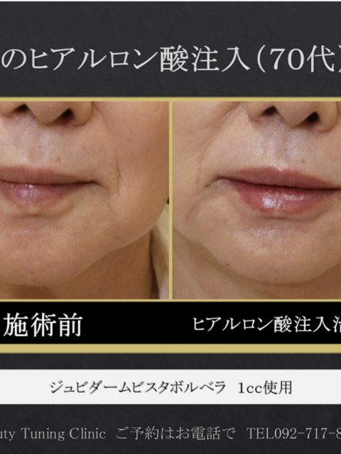 唇の加齢性変化とヒアルロン酸注入症例