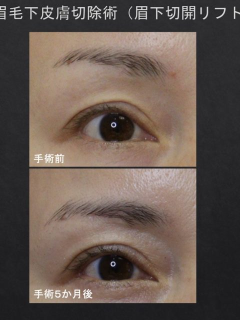 眉毛下皮膚切除術による 　まぶたのタルミ治療　(眉下リフト）