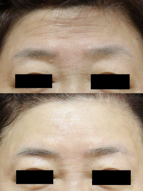 額のシワへの複合治療（ヒアルロン酸注入、眉下切開、ボトックス）