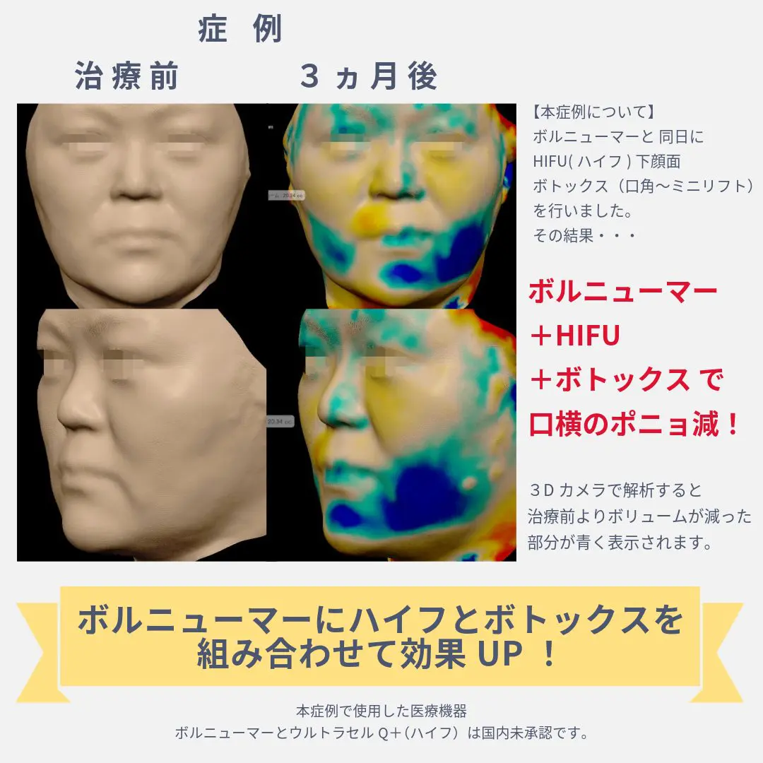 ボルニューマー症例 : 同日にハイフとボトックスで 効果アップ！3ヶ月