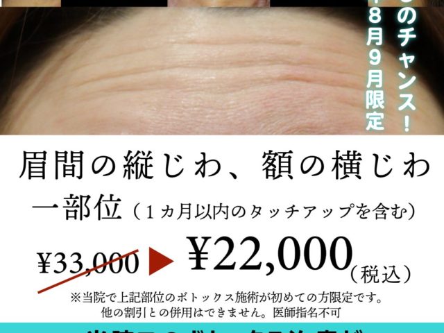 お試しボトックス割引（眉間、額）期間限定！（2025年8月9月）